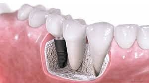 Dental Implant, Tooth Replacement, New Tooth, Missing Tooth