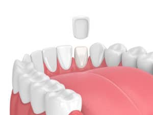 Best Veneer Dentist Wilmington NC