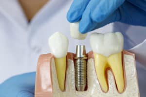 Dental Implant North Carolina