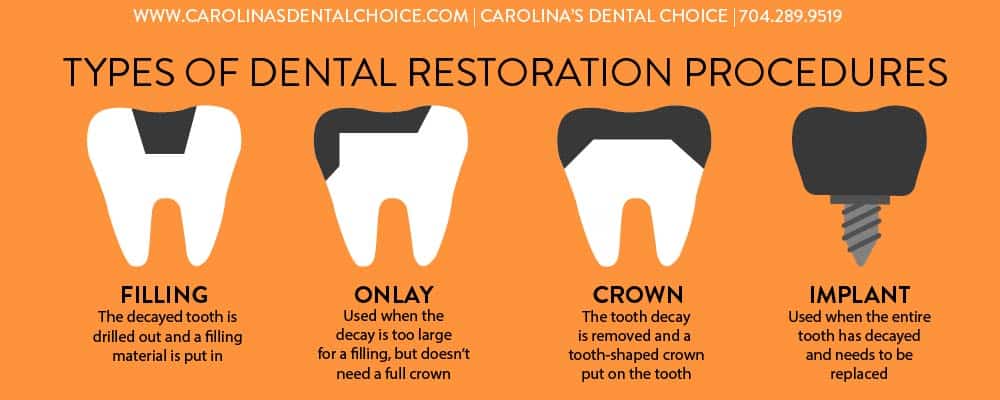 Cosmetic Dental Service - Crowns