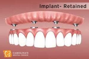 Implant Overdentures