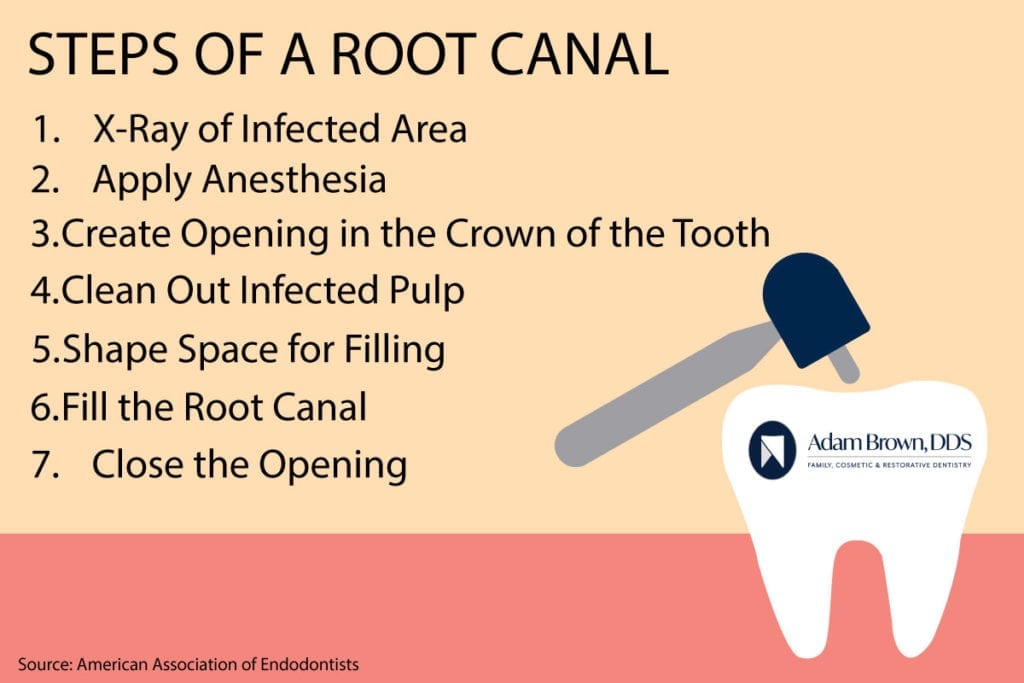 Root canal charlotte nc affordable root canal adam brown dds