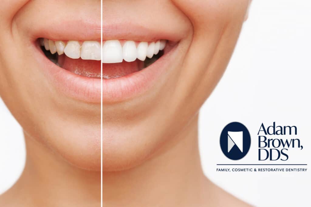 Teeth Bonding vs. Veneers Which Is Right for You? Adam Brown