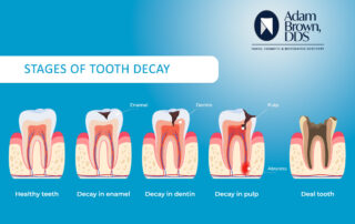 What is a Cavity?