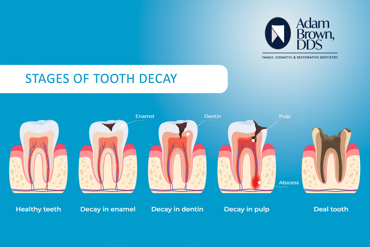 What is a Cavity?