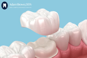 Gold tooth crown cost, porcelain tooth crown cost, Resin tooth crown cost