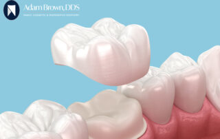 Gold tooth crown cost, porcelain tooth crown cost, Resin tooth crown cost