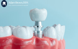 Considering dental implants in Monroe, NC