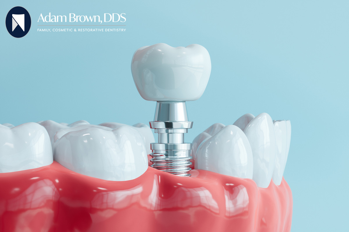 Considering dental implants in Monroe, NC